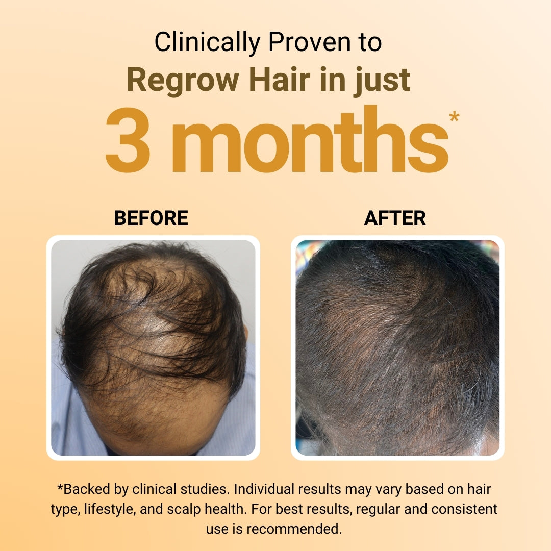 Before and after hair growth treatment showing a person's head with hair loss on the left and regrowth on the right, set against a beige background.